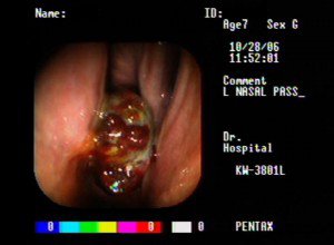 Ethmoid Haematoma